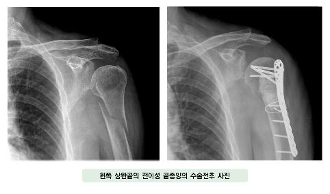 왼쪽 상완골의 전이성 골종양의 수술전후 사진