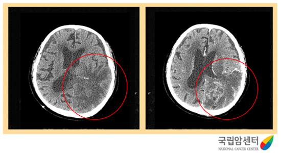 교모세포종의 뇌 전산화단층촬영 소견