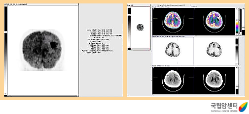 교모세포종의 양전자방출단층촬영 소견
