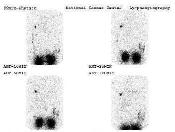 상지 림프부종환자의 림프신티그라피 영상