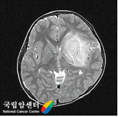 고등급 성상세포종