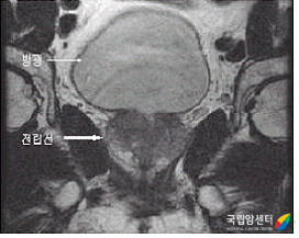 전립선암의 MRI 소견 - 방광, 전립선