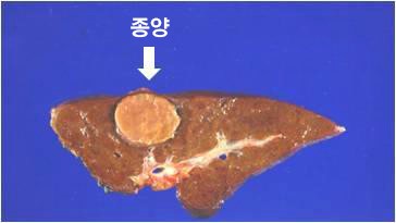 간절제술 후 간절제 부분의 육안 사진