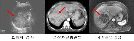 간암의 진단방법 ( 초음파 검사, 전산화단층촬영, 자기공명영상 사진)