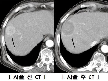 고주파 열치료술 시술 전후의 간암 비교(CT 영상)