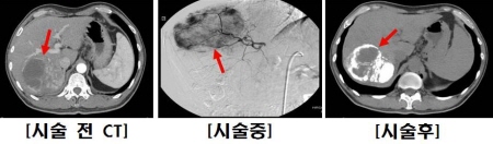 경동맥화학색전술에 의한 간암의 변화(시술 전, 시술 중, 시술 후의 CT 영상)