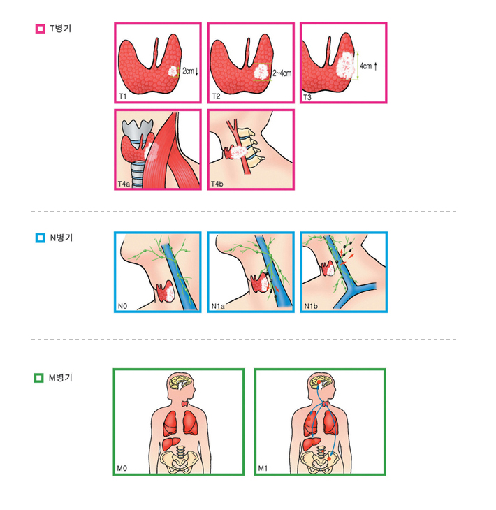 갑상선암의 병기 T병기 T1, 2cm, T2 2~4cm T3, 4cm, T4a, T4b,  N병기 N0, N1a, N1b,  M병기 M0, M1