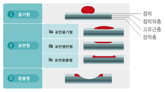 조기위암의 육안분류 I 융기형, II 표면형 (IIa 표면융기형, IIb 표면평탄형, IIc 표면함몰형) , 점막, 점막하층, 고유근층, 장막층 