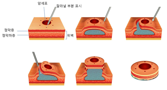 내시경적 점막하박리술 - 위벽 (점막층, 점막하층), 암세포, 잘라낼 부분 표시