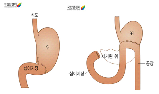 위아전절제술 후의 소화기계 구조 - 식도, 위, 십이지장,  위, 제거된 위, 십이지장, 공장