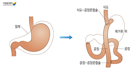 위전절제술후의 소화기계 구조 - 식도, 식도-공장문합술, 제거된 위, 공장, 공장-공장문합술