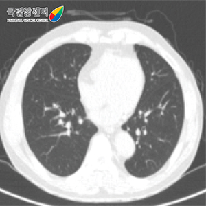 저선량흉부-횡단면영상