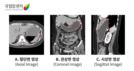 혈관 조영제(약 2리터) 섭취한 영상 [국립암센터] A. 횡단면 영상(Axial Image) / B. 관상면 영상(Coronal Image) / C. 시상면 영상(Sagittal Image)