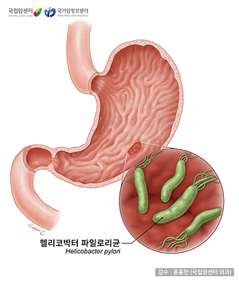 개의 림프절 전체가 부은 것은 암을 의미합니까